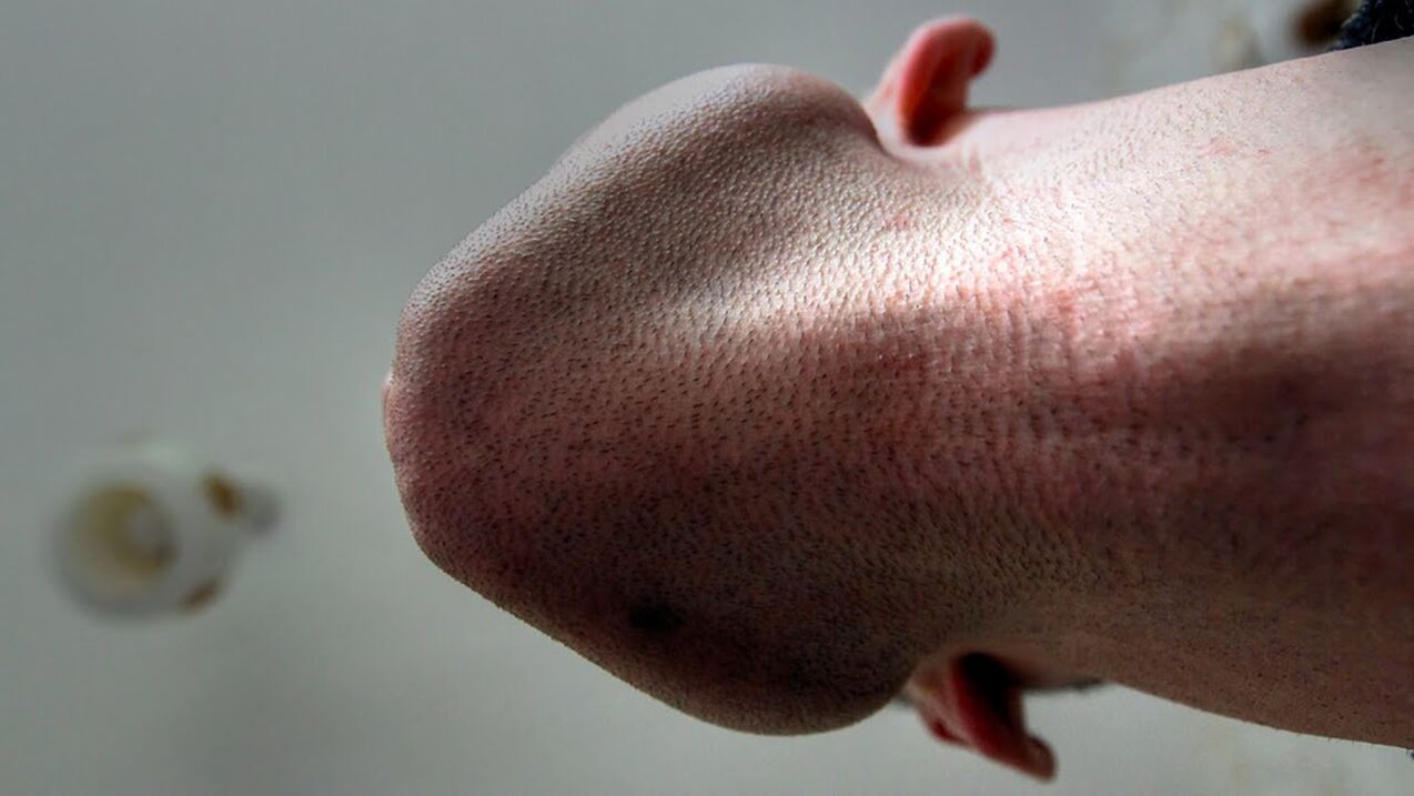E puer Produkter fir de Kapp vum Penis ze vergréisseren kënnen Allergien verursaachen