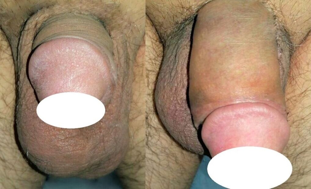 Fotoen virun an no der Penis Erweiderung